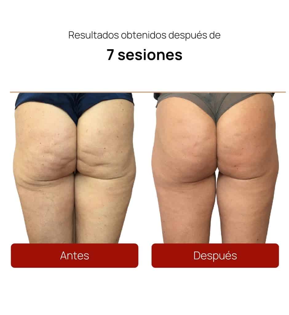 Antes y después Alidya