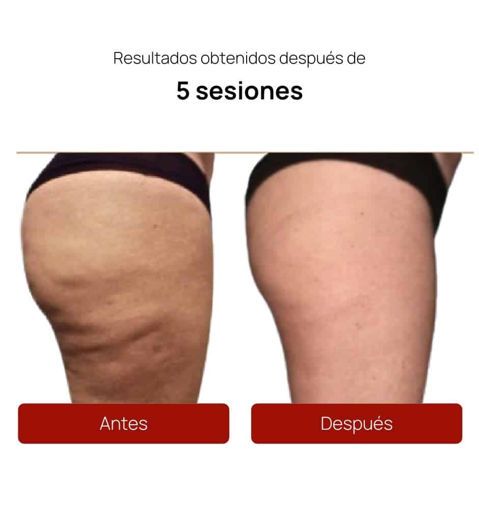 Antes y después Alidya