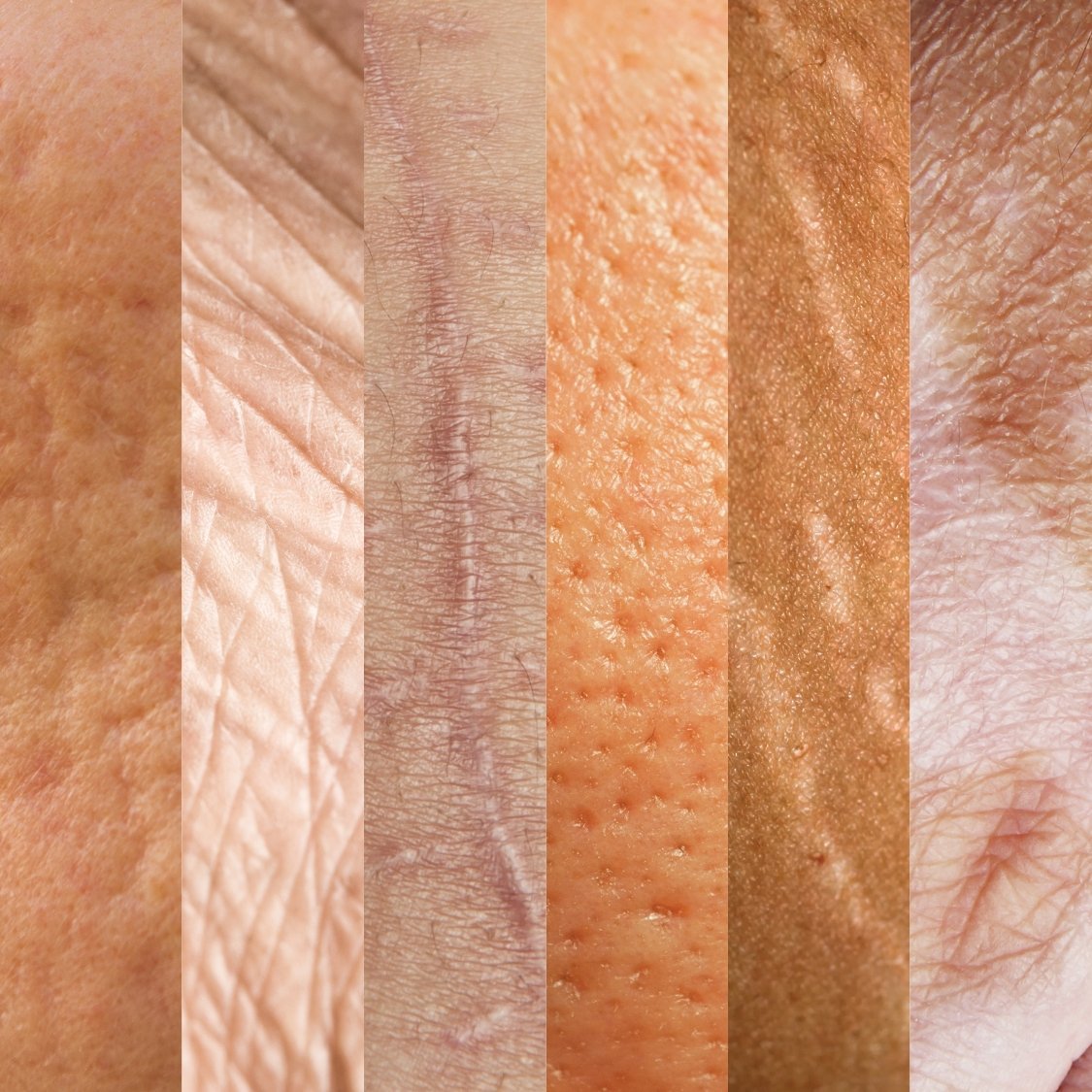 Indicaciones SkinPen