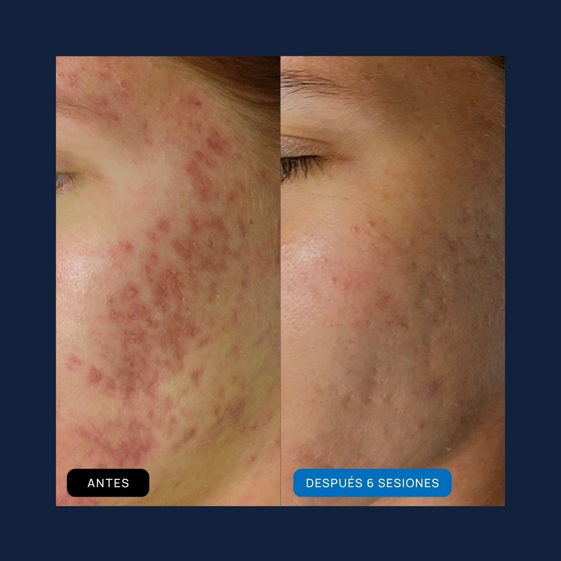 Indicaciones SkinPen