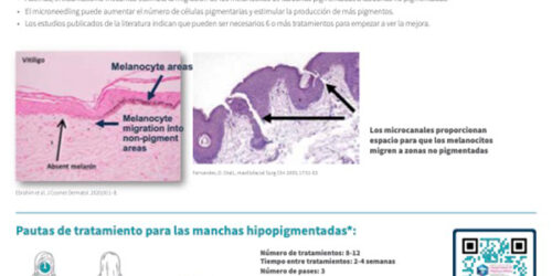 SkinPen Precision y Manchas Hipopigmentadas