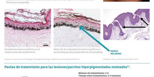 SkinPen Precision y Lesiones/Parches Hiperpigmentados Moteados