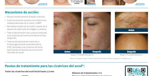 SkinPen Precision y Cicatrices de Acné