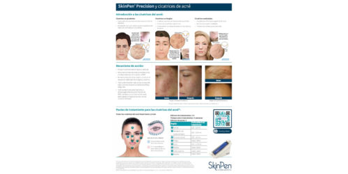SkinPen Precision y Cicatrices de Acné