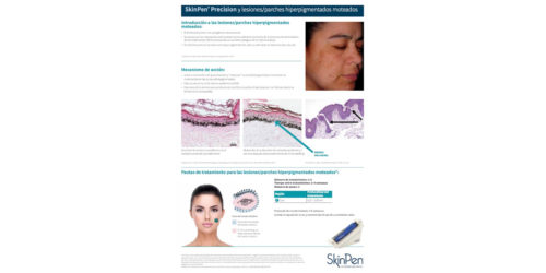 SkinPen Precision y Lesiones/Parches Hiperpigmentados Moteados