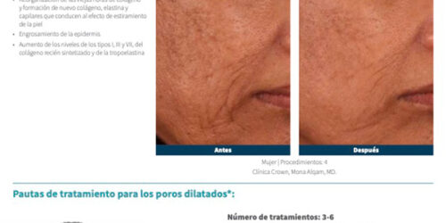 SkinPen Precision y Poros Dilatados