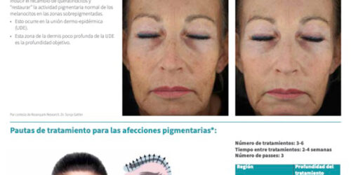 SkinPen Precision y Afecciones de la Pigmentación