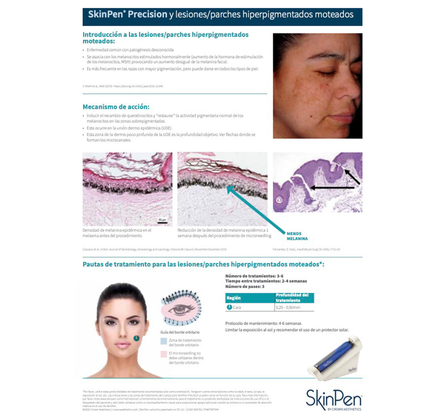SkinPen Precision y Lesiones/Parches Hiperpigmentados Moteados