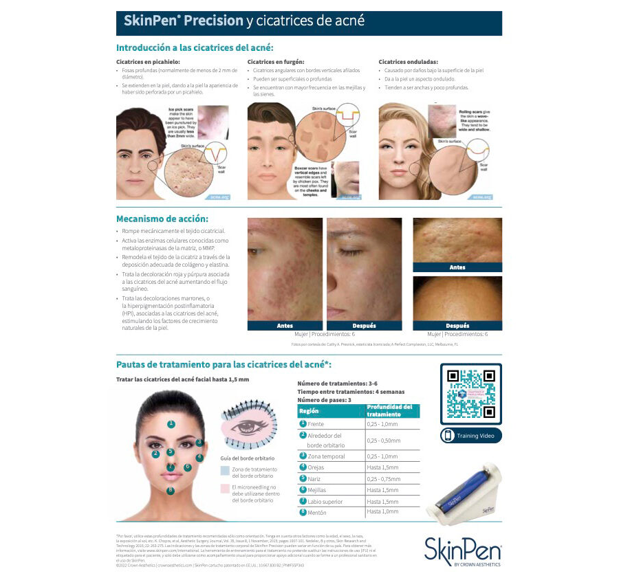 SkinPen Precision y Cicatrices de Acné